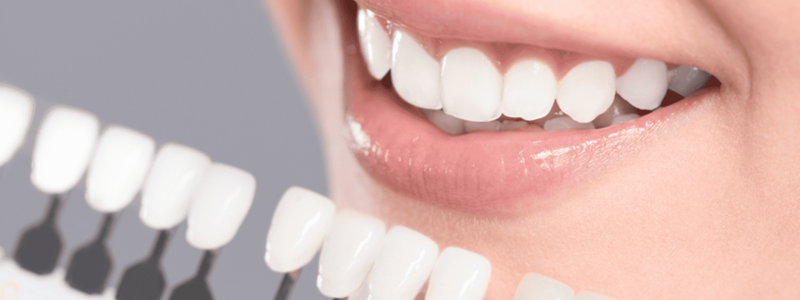 5 Benefits of Dental Veneers