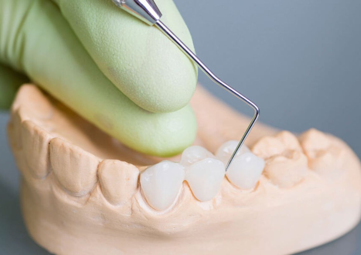 Dental Bridges in South Boston Dental Care